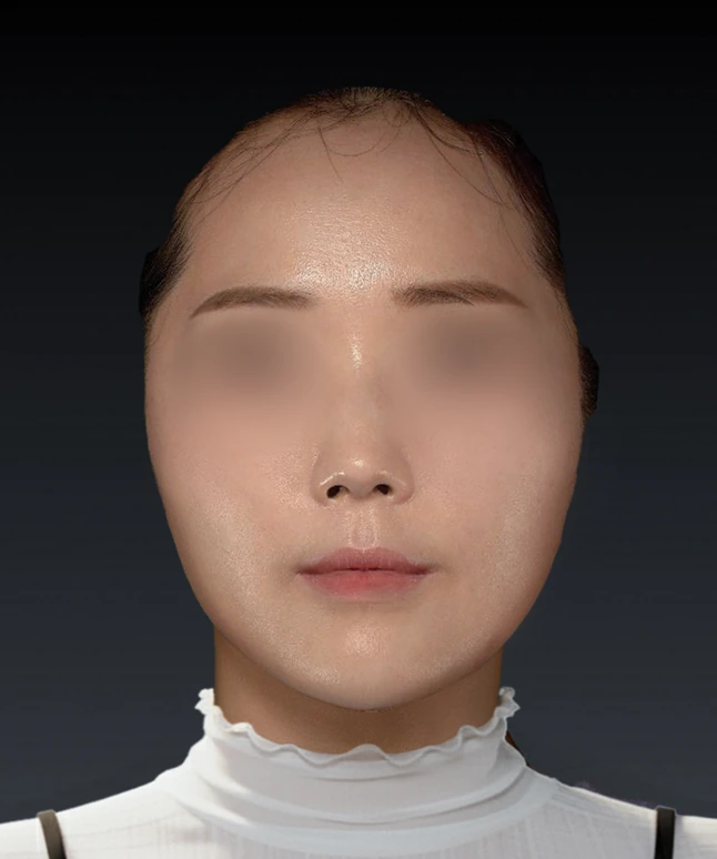 스컬트라 시술 후 얼굴 정면 1