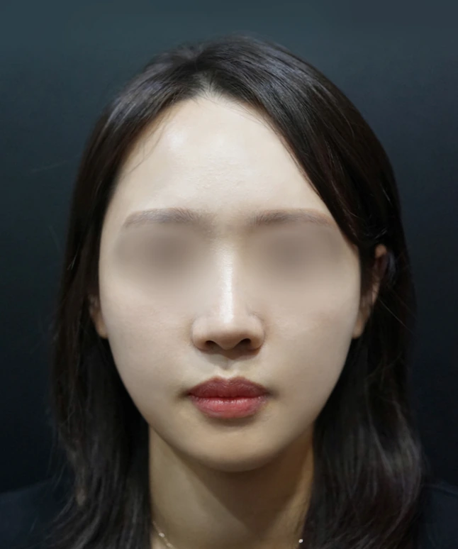스컬트라 시술 후 얼굴 정면 3