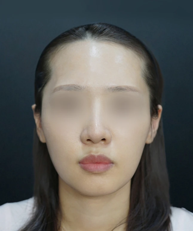 스컬트라 시술 전 얼굴 정면 3